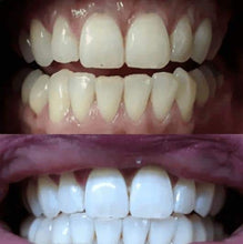 Load image into Gallery viewer, Snow® At-Home Teeth Whitening Kit