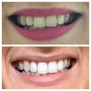 Snow® Teeth Whitening At-Home System [FabFitFun Exclusive]